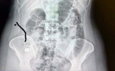 Literatürde rastlanılmayan olay: Boynuna takılan implant yemek borusunu deldi