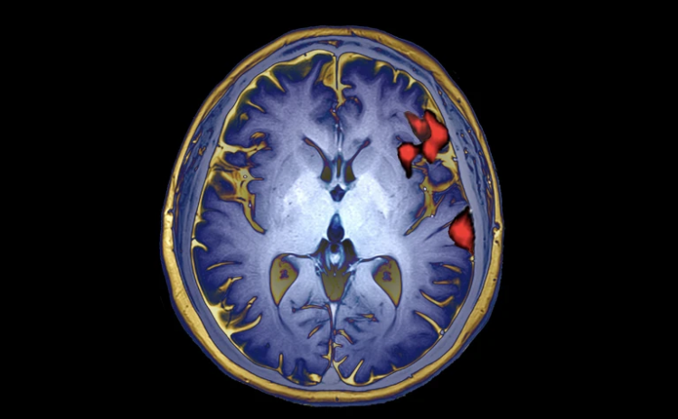 Yeni beyin implantı düşünceleri iki dilde aktarabiliyor