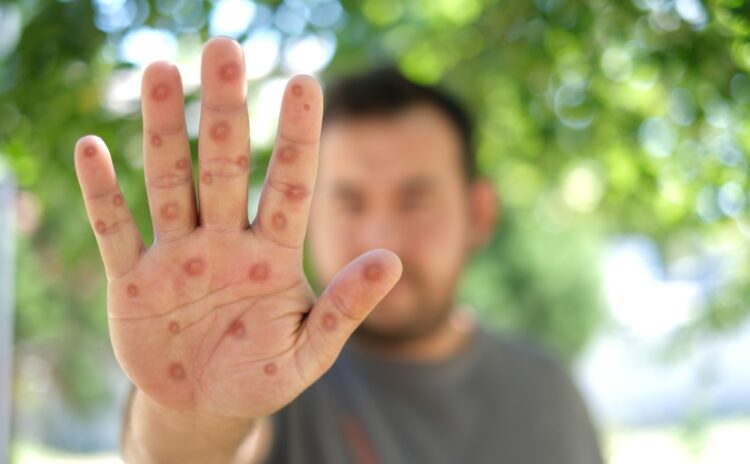 M çiçeği alarmı: Şimdi neden daha tehlikeli?