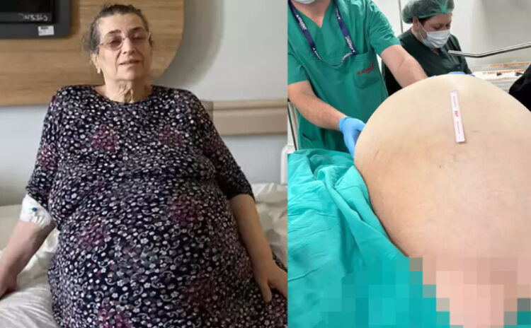 Yumurtalıklarından 23 kilo kitle çıktı, yaşaması mucize