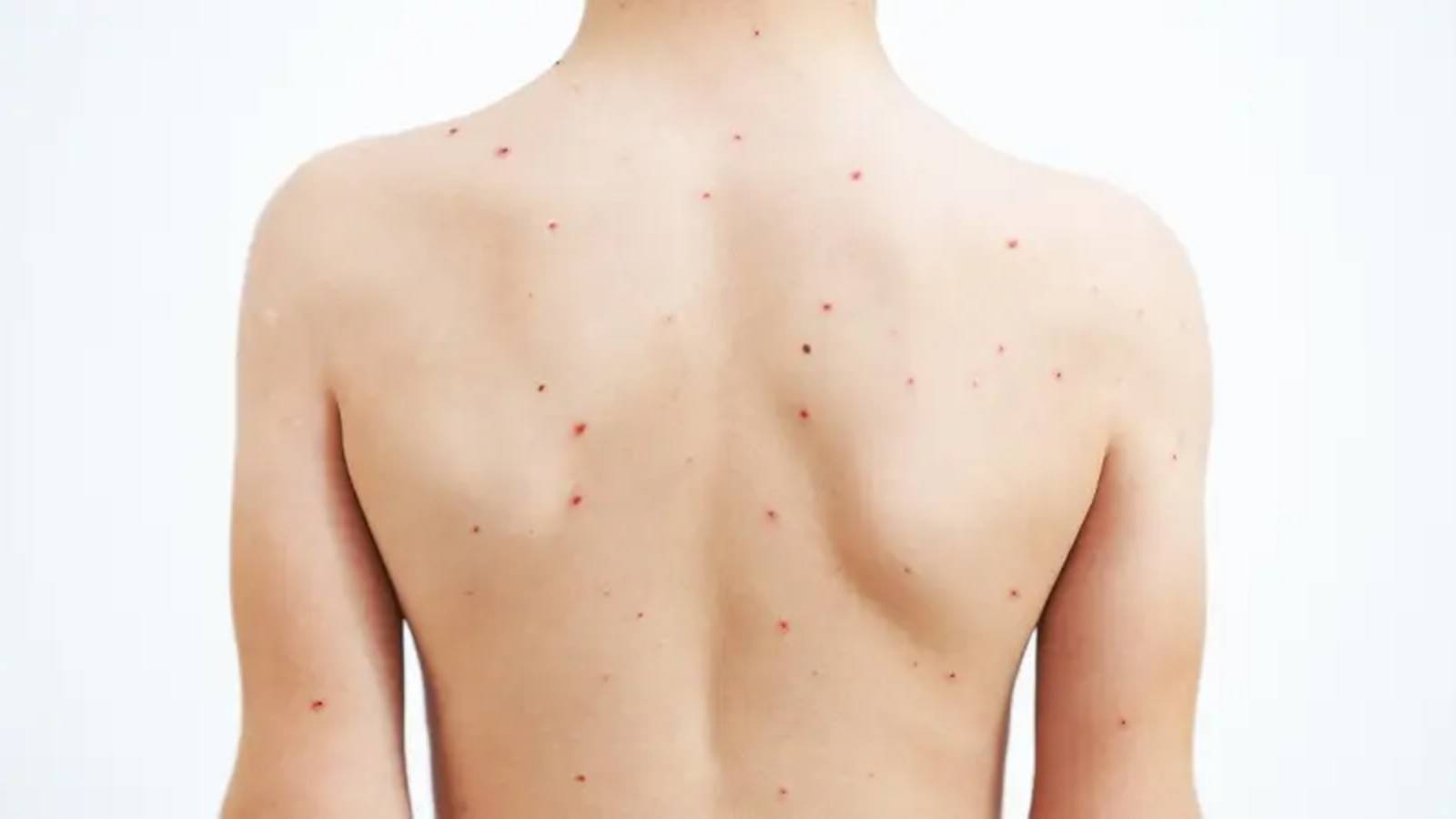 ‘Su çiçeği’ okullara geri döndü: Uzmanlar ‘belirti varsa çocuğunuzu okula göndermeyin’ diyor