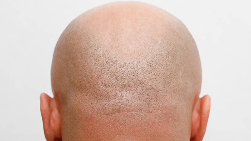 Saç dökülmesine karşı bin yıllık bitkiden umut: ‘He Shou Wu’