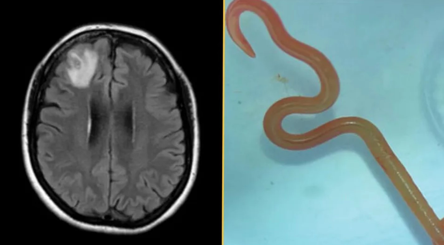 Oraya kadar ilerlediğine ilk kez tanık olundu: Beyninden canlı solucan çıktı