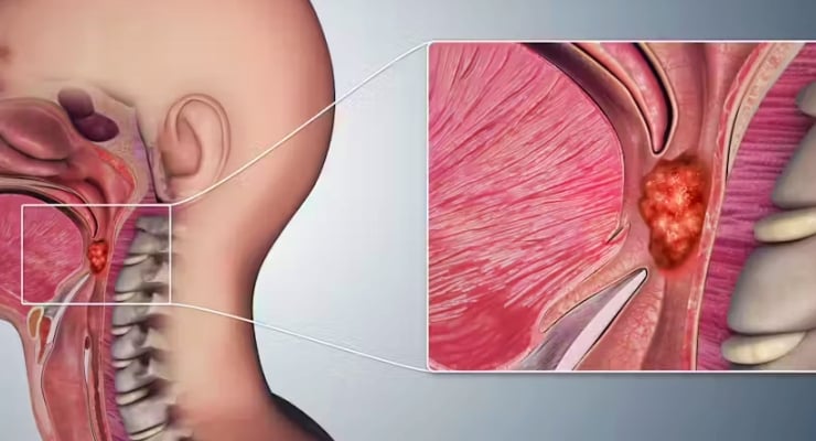 Kimin aklına gelir: Bir çeşit gırtlak kanserinin baş nedeni oral seks